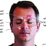التهاب الجيوب الأنفية