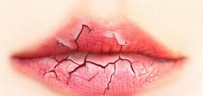 وتشقق_الشفاه