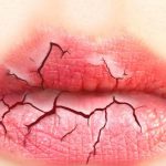 تشقق الشفتين