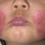 الإصابات الجلدية الشائعة عند الأطفال