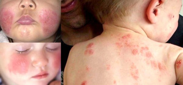 alergie-e1532879486256