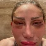 نجوم عرضوا حياتهم للخطر بسبب التجميل